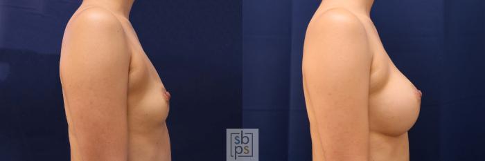 Before & After Breast Augmentation Case 589 Right Side View in Torrance, CA