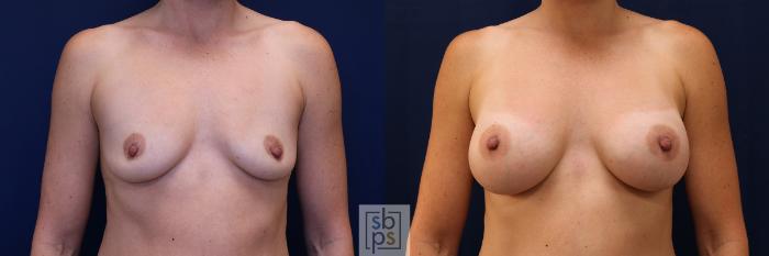 Before & After Breast Augmentation Case 590 Front View in Torrance, CA