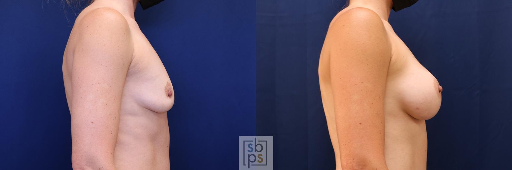 Before & After Breast Augmentation Case 590 Left Side View in Torrance & Los Angeles, CA, CA