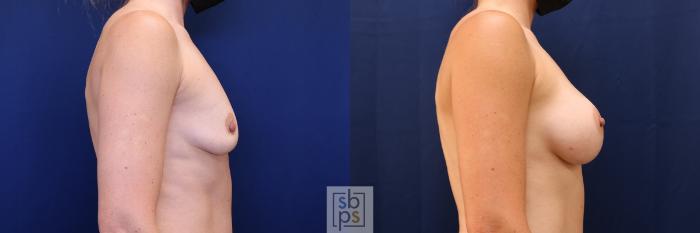 Before & After Breast Augmentation Case 590 Left Side View in Torrance, CA