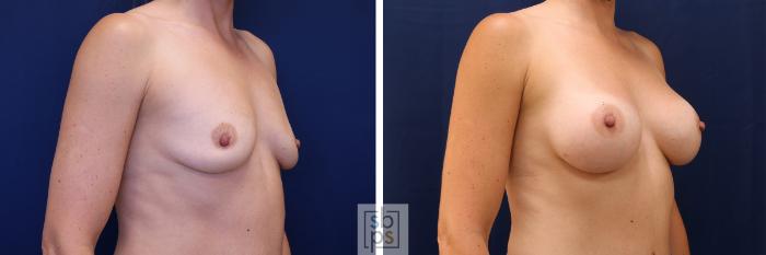 Before & After Breast Augmentation Case 590 Right Oblique View in Torrance, CA