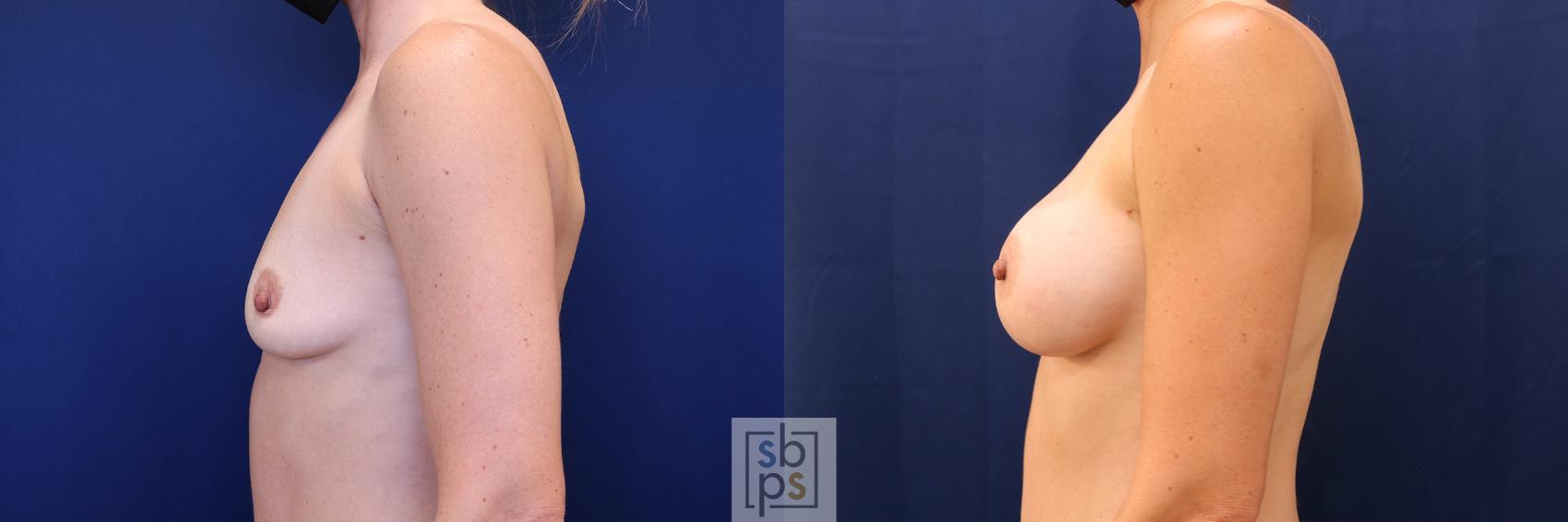 Before & After Breast Augmentation Case 590 Right Side View in Torrance & Los Angeles, CA, CA