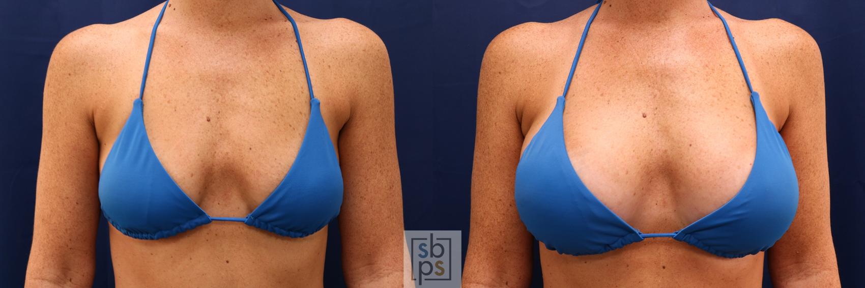 Before & After Breast Augmentation Case 591 Bikini Front View in Torrance & Los Angeles, CA, CA