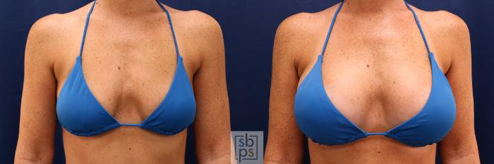 Before & After Breast Augmentation Case 591 Bikini Front View in Torrance, CA