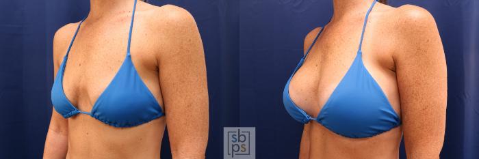 Before & After Breast Augmentation Case 591 Bikini Left Oblique View in Torrance, CA