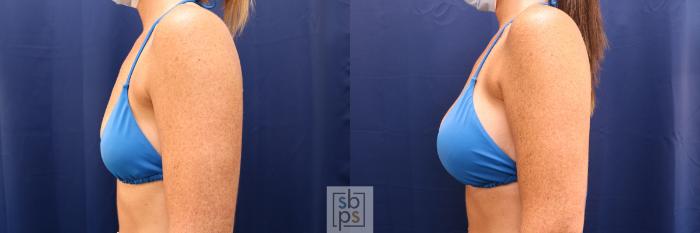 Before & After Breast Augmentation Case 591 Bikini Left View in Torrance, CA