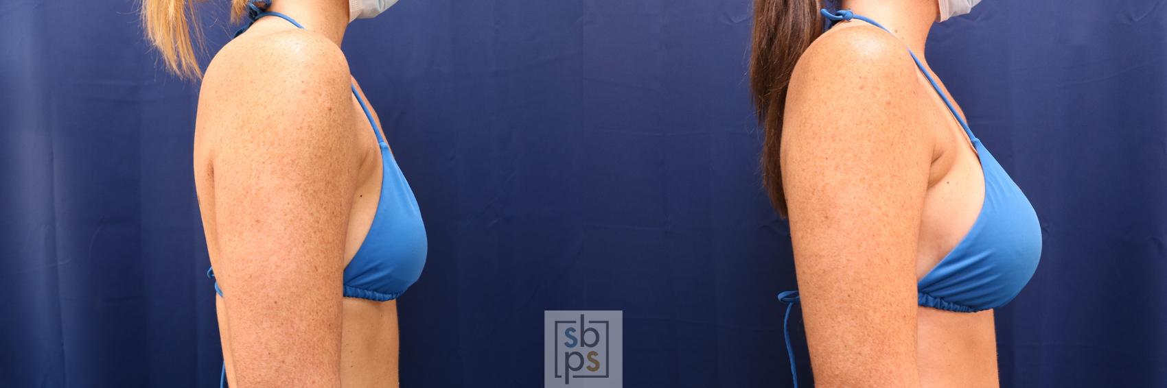 Before & After Breast Augmentation Case 591 Bikini Right View in Torrance & Los Angeles, CA, CA