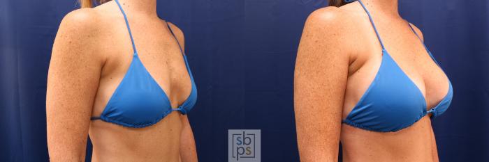 Before & After Breast Augmentation Case 591 Bikini Right Oblique View in Torrance, CA