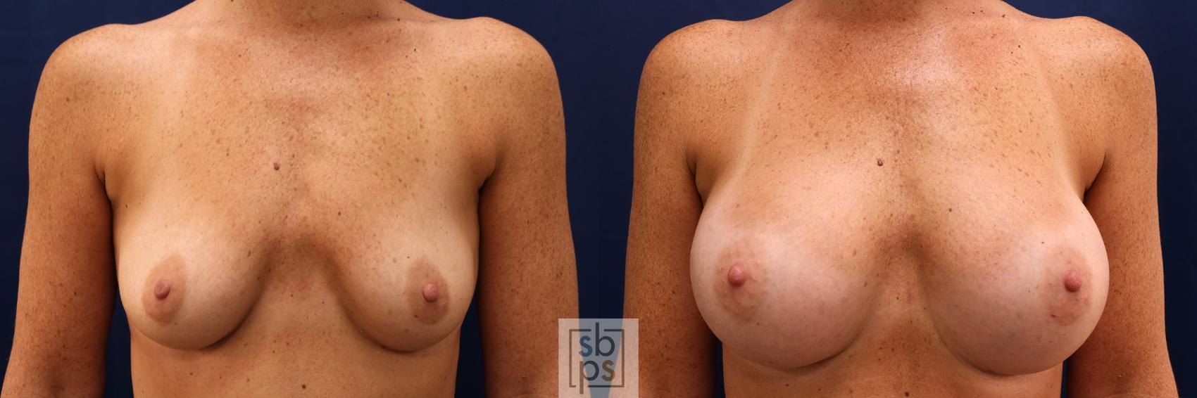 Before & After Breast Augmentation Case 591 Front View in Torrance, CA