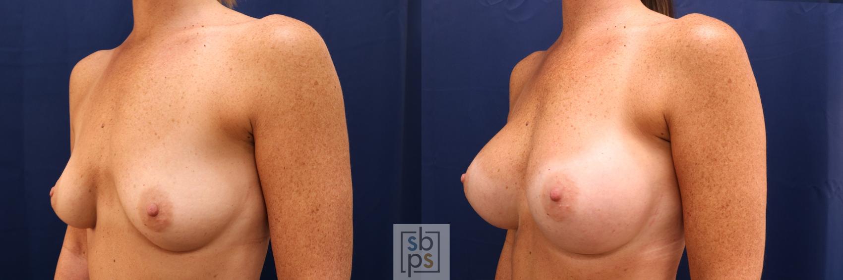 Before & After Breast Augmentation Case 591 Left Oblique View in Torrance & Los Angeles, CA, CA