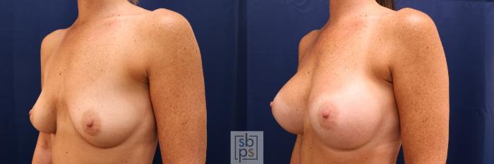 Before & After Breast Augmentation Case 591 Left Oblique View in Torrance, CA