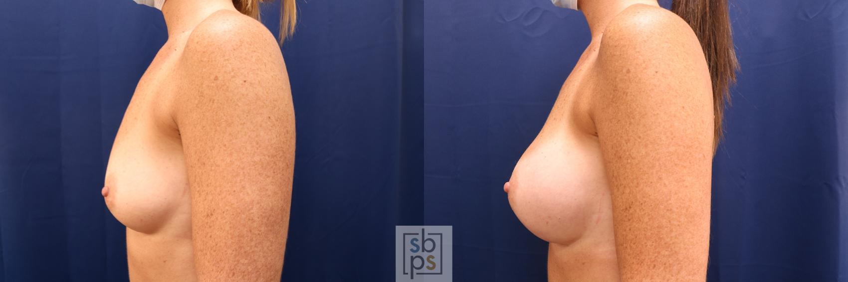 Before & After Breast Augmentation Case 591 Left Side View in Torrance & Los Angeles, CA, CA