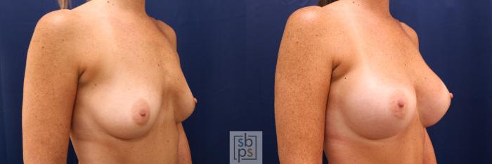 Before & After Breast Augmentation Case 591 Right Oblique View in Torrance, CA