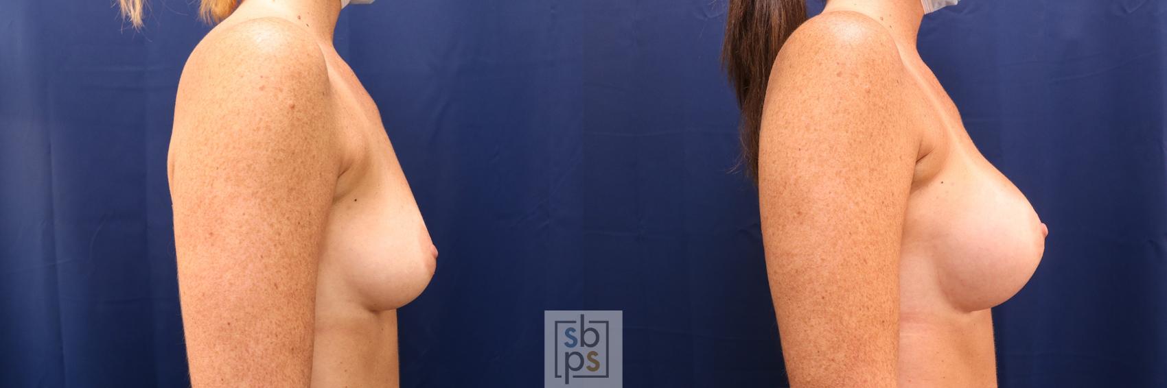 Before & After Breast Augmentation Case 591 Right Side View in Torrance & Los Angeles, CA, CA