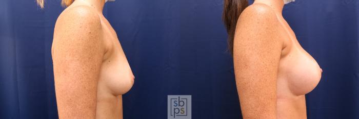 Before & After Breast Augmentation Case 591 Right Side View in Torrance, CA