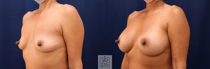 Before & After Breast Augmentation Case 601 Left Oblique View in Torrance, CA