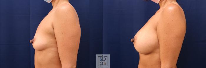 Before & After Breast Augmentation Case 601 Left Side View in Torrance, CA