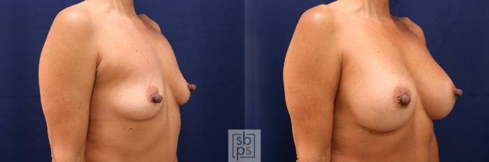 Before & After Breast Augmentation Case 601 Right Oblique View in Torrance, CA