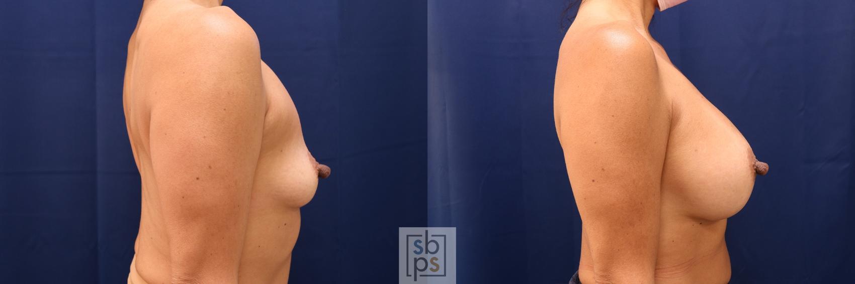 Before & After Breast Augmentation Case 601 Right Side View in Torrance & Los Angeles, CA, CA