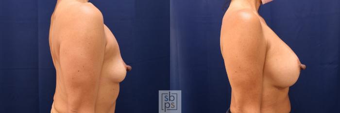 Before & After Breast Augmentation Case 601 Right Side View in Torrance, CA