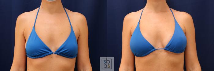 Before & After Breast Augmentation Case 603 Bikini Front View in Torrance, CA