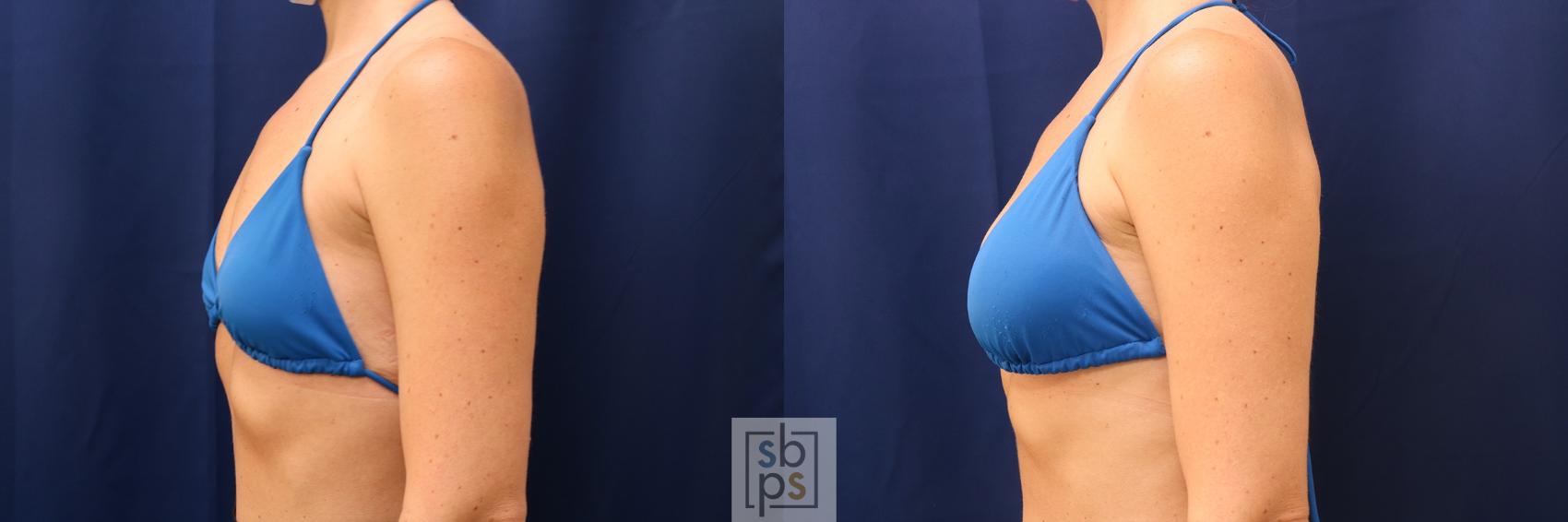 Before & After Breast Augmentation Case 603 Bikini Left View in Torrance & Los Angeles, CA, CA