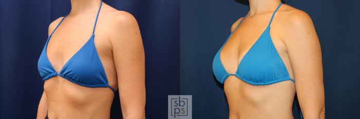 Before & After Breast Augmentation Case 603 Bikini Left Oblique View in Torrance, CA