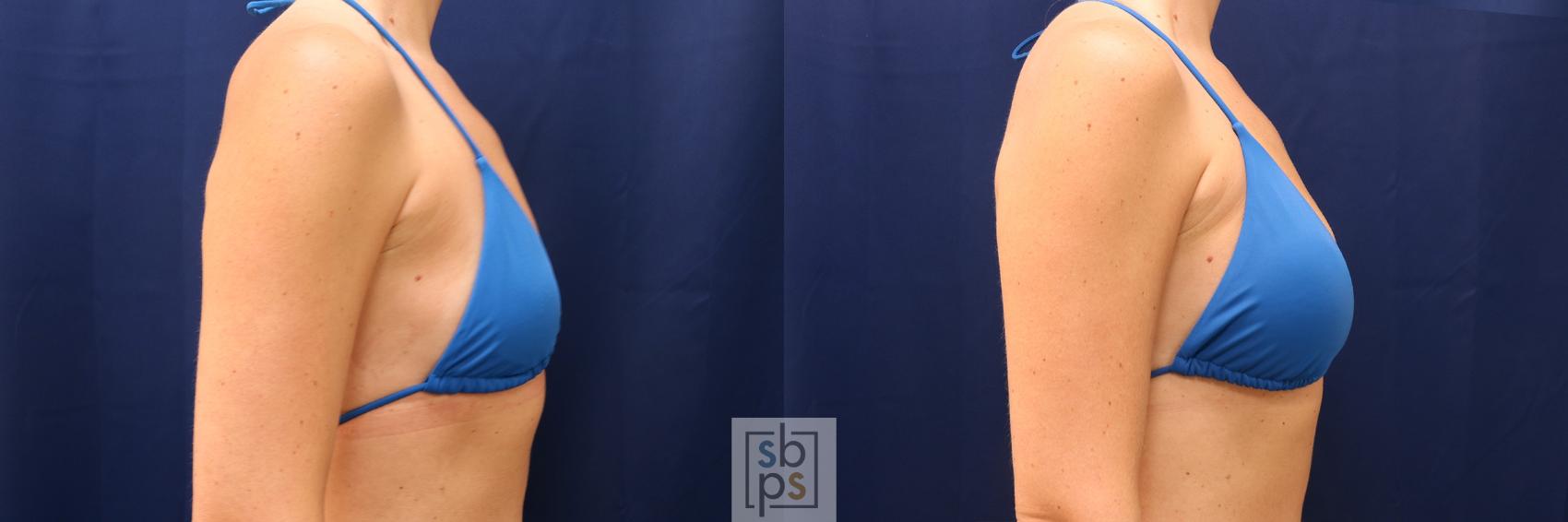 Before & After Breast Augmentation Case 603 Bikini Right View in Torrance & Los Angeles, CA, CA