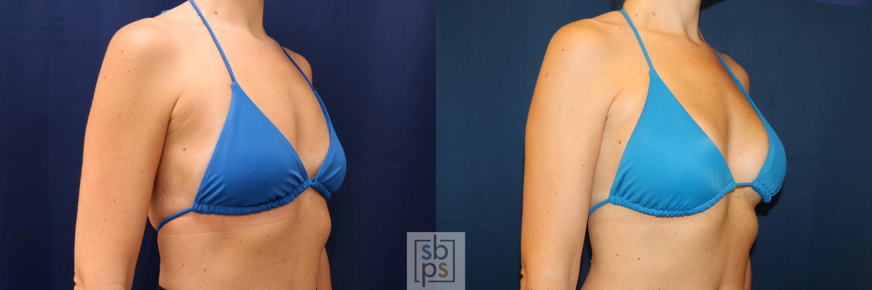 Before & After Breast Augmentation Case 603 Bikini Right Oblique View in Torrance & Los Angeles, CA, CA