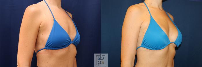 Before & After Breast Augmentation Case 603 Bikini Right Oblique View in Torrance, CA