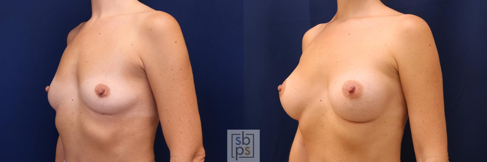 Before & After Breast Augmentation Case 603 Left Oblique View in Torrance & Los Angeles, CA, CA