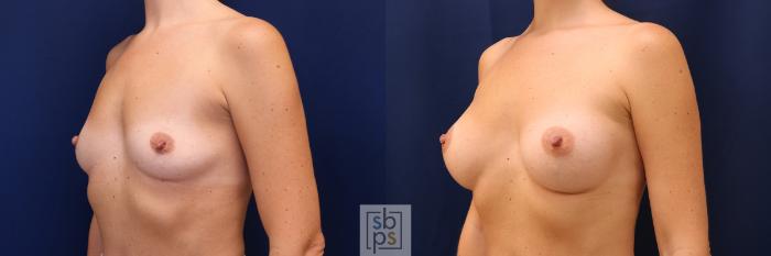 Before & After Breast Augmentation Case 603 Left Oblique View in Torrance, CA