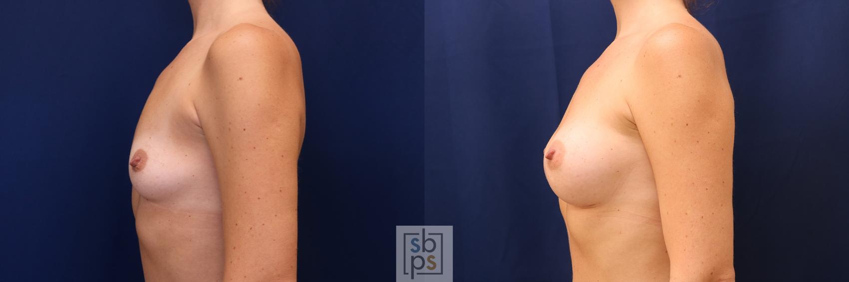 Before & After Breast Augmentation Case 603 Left Side View in Torrance & Los Angeles, CA, CA