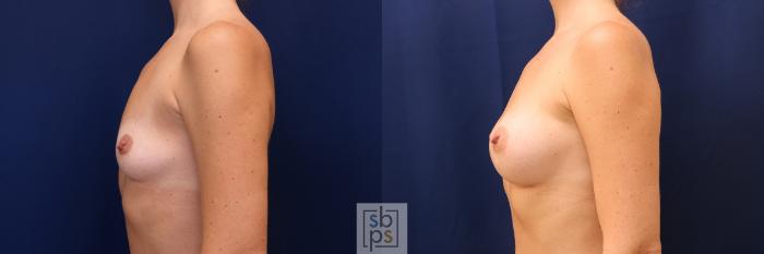 Before & After Breast Augmentation Case 603 Left Side View in Torrance, CA