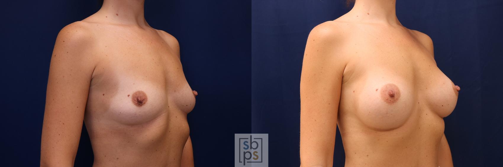 Before & After Breast Augmentation Case 603 Right Oblique View in Torrance & Los Angeles, CA, CA