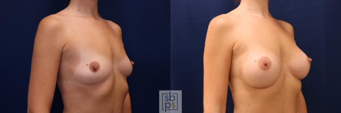 Before & After Breast Augmentation Case 603 Right Oblique View in Torrance, CA