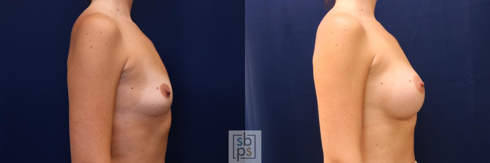 Before & After Breast Augmentation Case 603 Right Side View in Torrance & Los Angeles, CA, CA