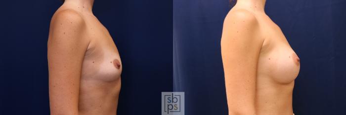 Before & After Breast Augmentation Case 603 Right Side View in Torrance, CA