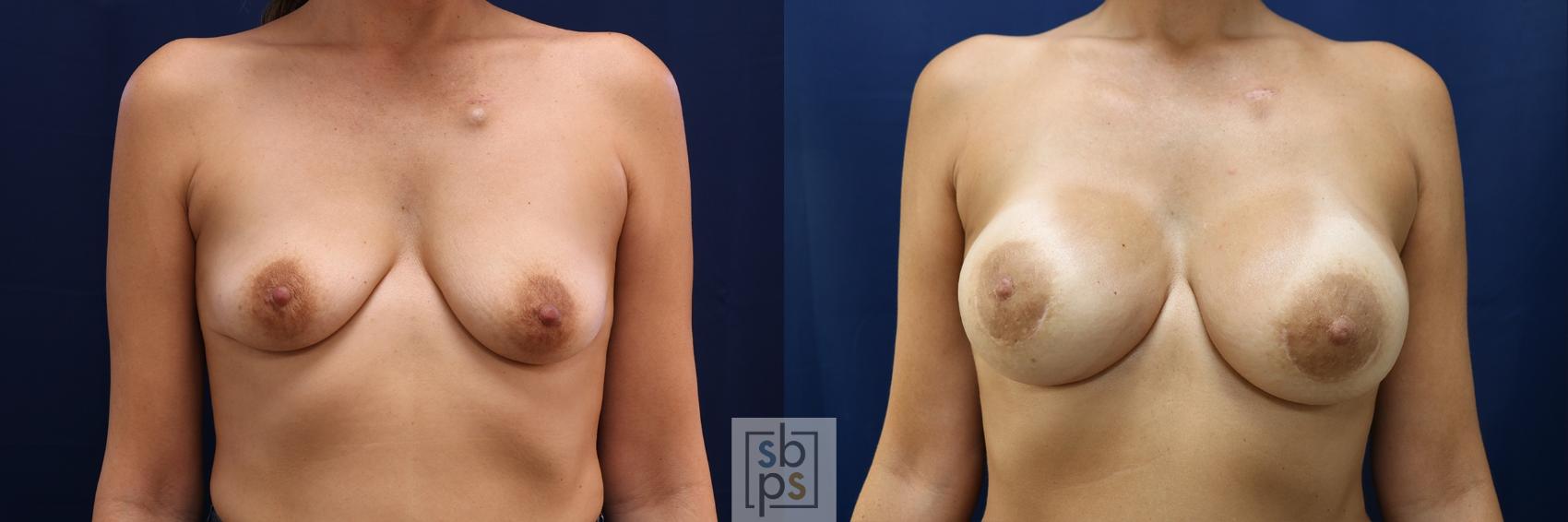 Before & After Breast Augmentation Case 606 Front View in Torrance, CA