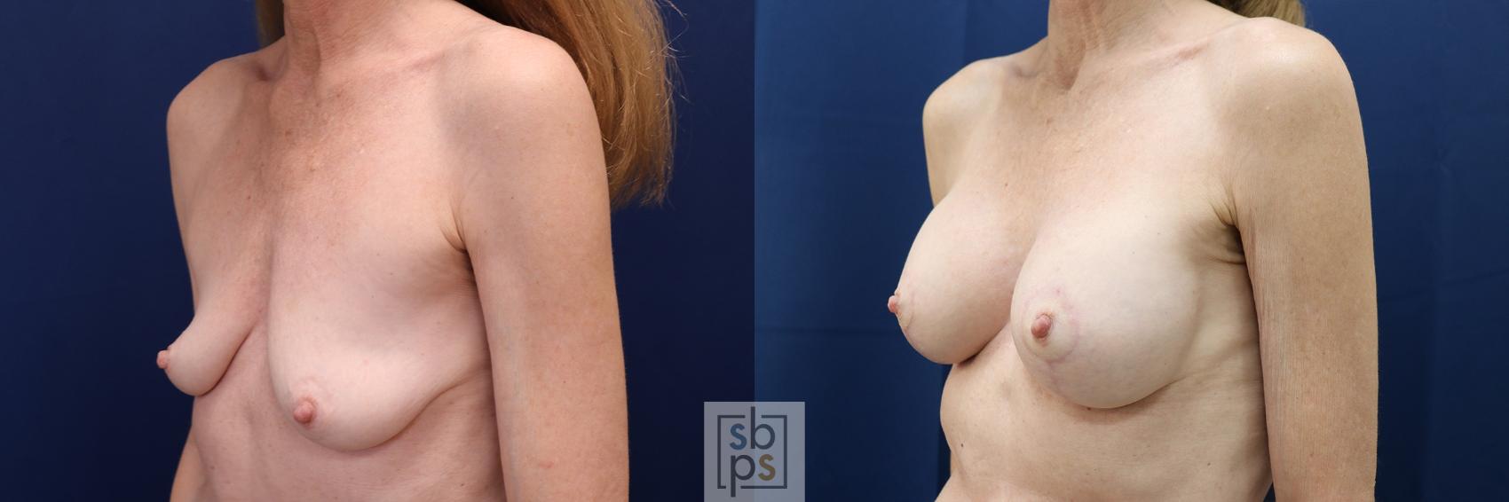 Before & After Breast Augmentation Case 609 Left Oblique View in Torrance & Los Angeles, CA, CA