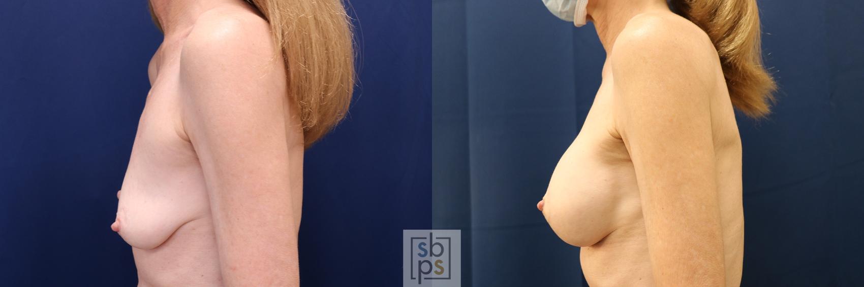 Before & After Breast Augmentation Case 609 Left Side View in Torrance & Los Angeles, CA, CA