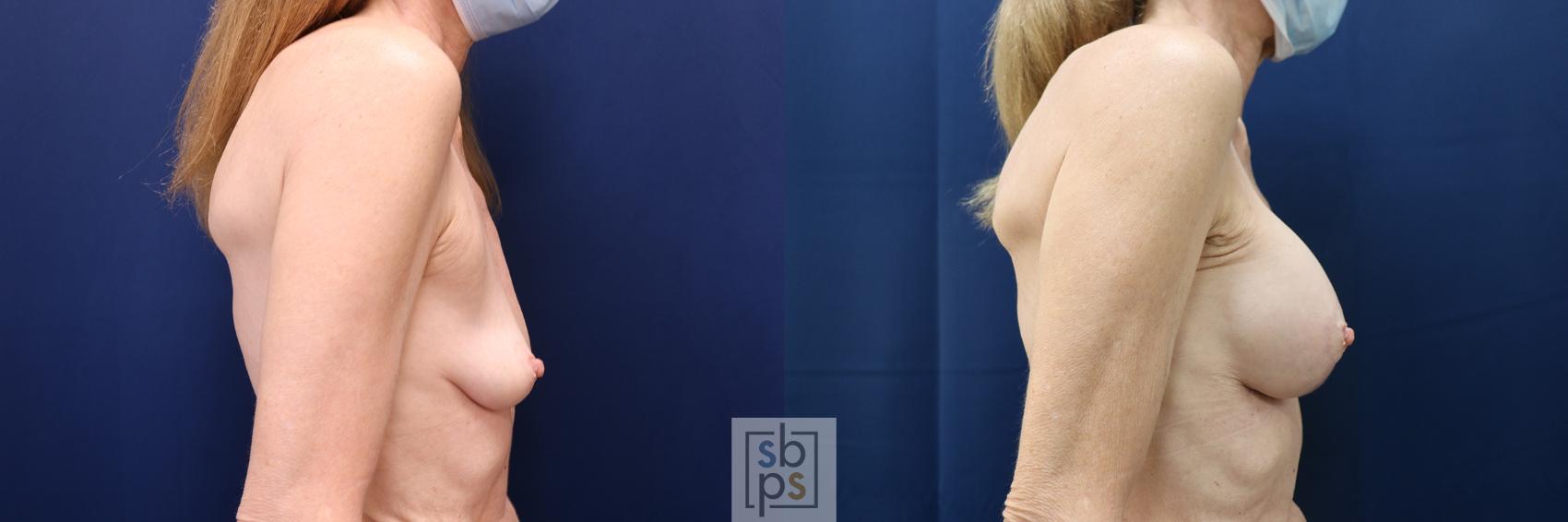 Before & After Breast Augmentation Case 609 Right Side View in Torrance & Los Angeles, CA, CA