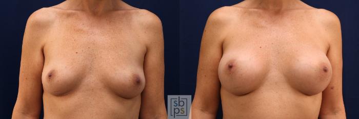 Before & After Breast Augmentation Case 612 Front View in Torrance, CA