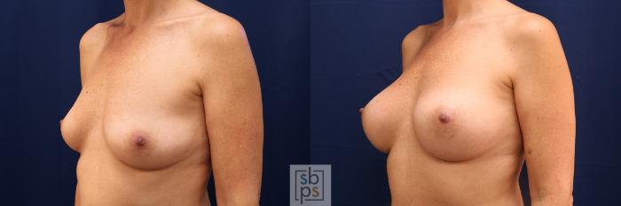 Before & After Breast Augmentation Case 612 Left Oblique View in Torrance, CA