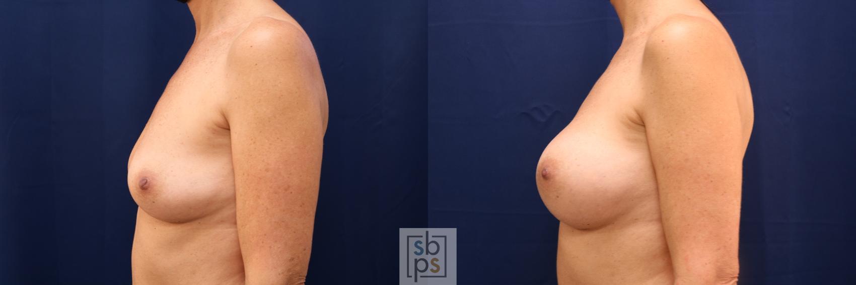 Before & After Breast Augmentation Case 612 Left Side View in Torrance & Los Angeles, CA, CA