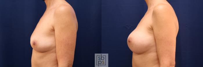 Before & After Breast Augmentation Case 612 Left Side View in Torrance, CA