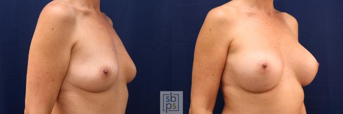 Before & After Breast Augmentation Case 612 Right Oblique View in Torrance, CA