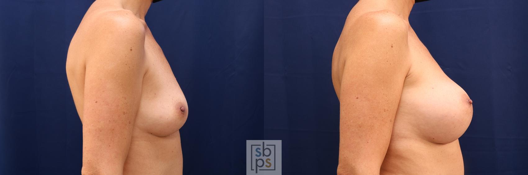 Before & After Breast Augmentation Case 612 Right Side View in Torrance & Los Angeles, CA, CA