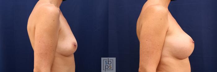 Before & After Breast Augmentation Case 612 Right Side View in Torrance, CA