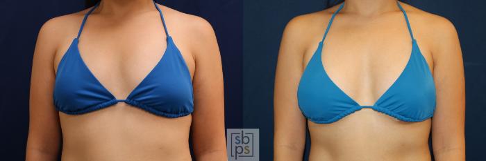 Before & After Breast Augmentation Case 620 Bikini Front View in Torrance, CA